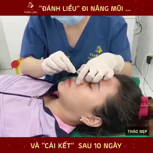 ĐẰNG SAU CHIẾC NẸP MŨI LÀ MỘT DÁNG MŨI NHƯ THẾ NÀO???