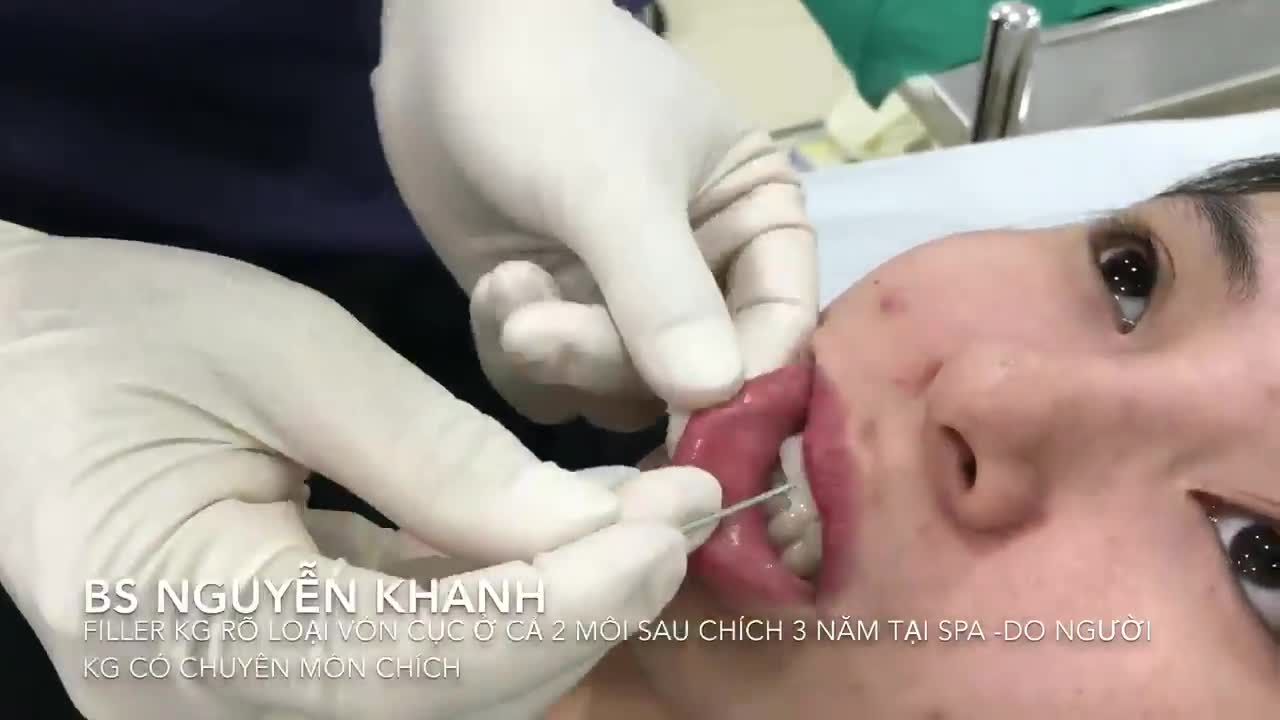 FILLER GIÁ RẺ CÓ THẬT “NGON-BỔ-RẺ” KHÔNG?