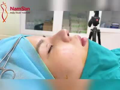 Khách hàng tin tưởng nên tiếp tục đến nâng mũi sau khi cắt mắt 1 tháng.