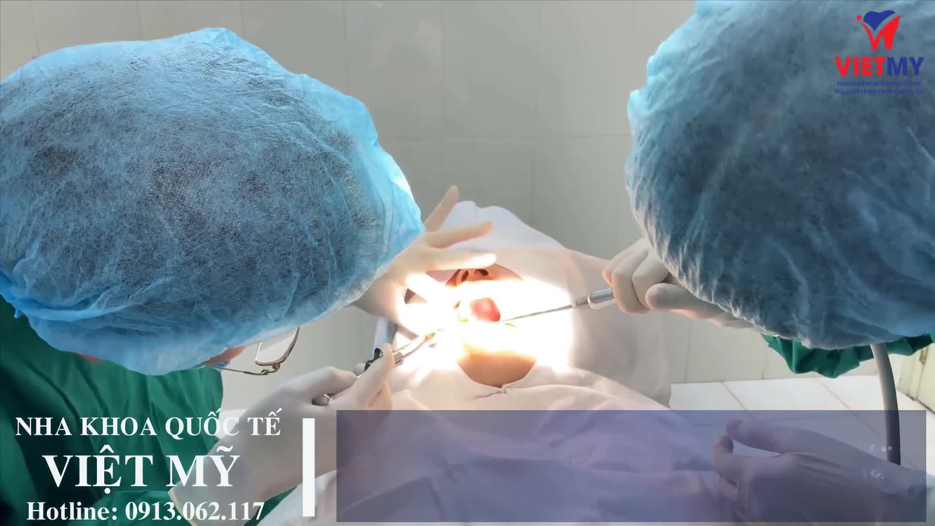 Tiếp tục là 1 Case Trồng răng Implant xâm lấn tối thiểu cho khách hàng mất răng hàm