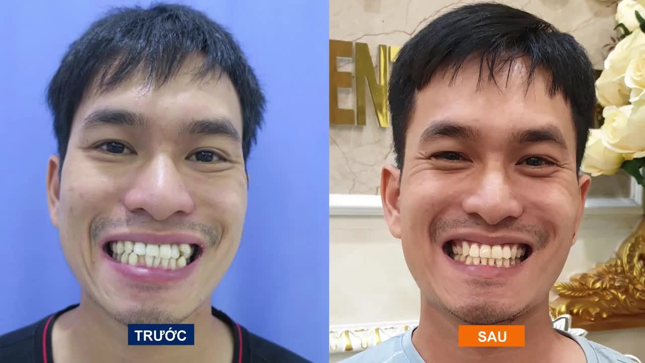 TỪ HẢI PHÒNG – ANH TRỊNH BÁ THẮNG LỰA CHỌN NHA KHOA QUỐC TẾ VIỆT ĐỨC TÌM LẠI NỤ CƯỜI TỰ TIN