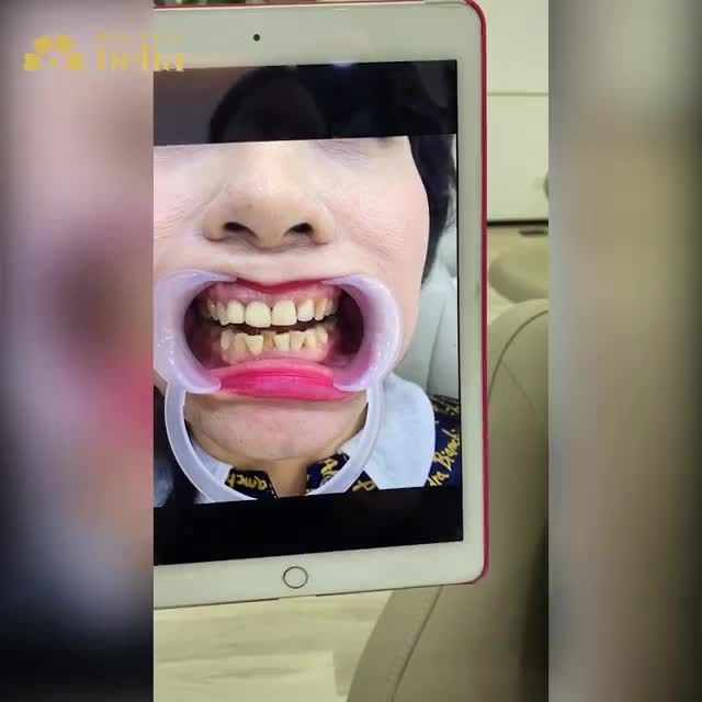 Từng làm răng sứ hỏng 2 lần từ 7 năm trước, KH Đặng Thị Sáu vượt 400km từ Hà Giang đến với nha khoa Delia và được giải cứu nụ cười chỉ sau 2 lần hẹn.