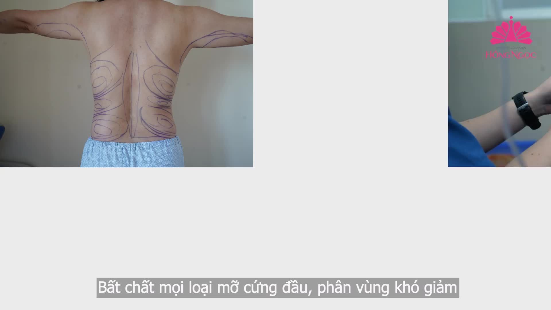 VASER LIPO POWER X BỘ ĐÔI “KHẮC TINH” CỦA MỌI TÌNH TRẠNG MỠ, EO THON – DÁNG GỌN CHỈ SAU 90P