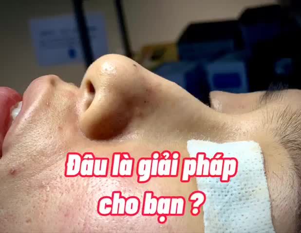 CHỈNH DÁNG MŨI GỒ HOÀN HẢO VỚI MỠ TỰ THÂN