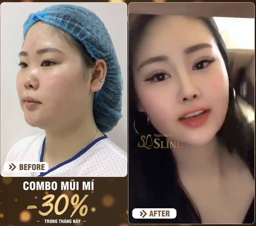 COMBO NHẤN MÍ - NÂNG MŨI CẤU TRÚC SOFTXIL... GIẢI PHÁP TỐI ƯU HOÀN THIỆN NHAN SẮC