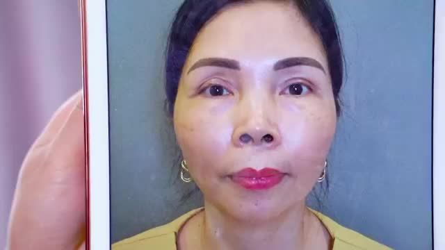 DR.HẢI LÊ GIẢI CỨU MÍ HỎNG KHẮC PHỤC MỌI NHƯỢC ĐIỂM CŨNG NHƯ BIẾN CHỨNG DO MÍ LỖI HỎNG GÂY RA BẰNG KỸ THUẬT SỬA MÍ DEEP TECH20