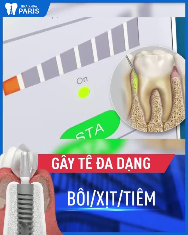 Khôi phục răng mất vĩnh viễn - 1 răng, nhiều răng, toàn hàm