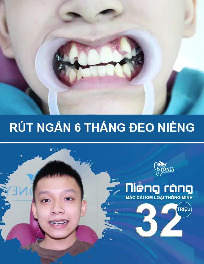 TẠI SAO RĂNG KHẤP KHỂNH LẠI CHỌN MẮC CÀI KIM LOẠI TỰ BUỘC