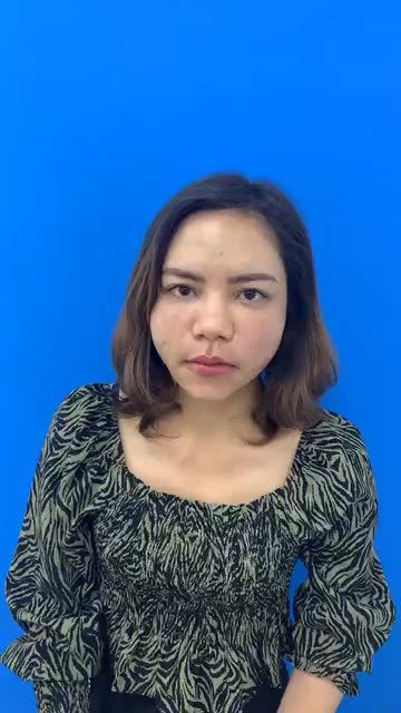 Tận mắt ngắm ngay kết quả sau 60 phút cấy mỡ toàn mặt biogen tại BV Đông Á