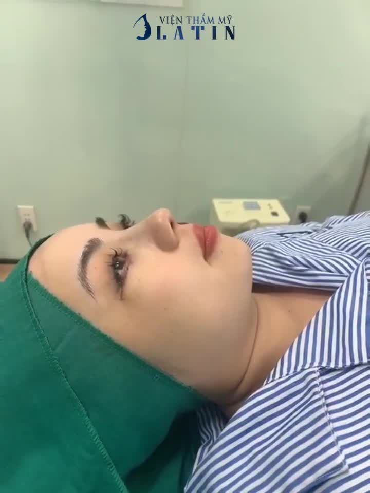 UPDATE 3 CHỊ EM Ở VINH - COMBO NÂNG MŨI BÁN CẤU TRÚC  CẮT MÍ DƯỚI