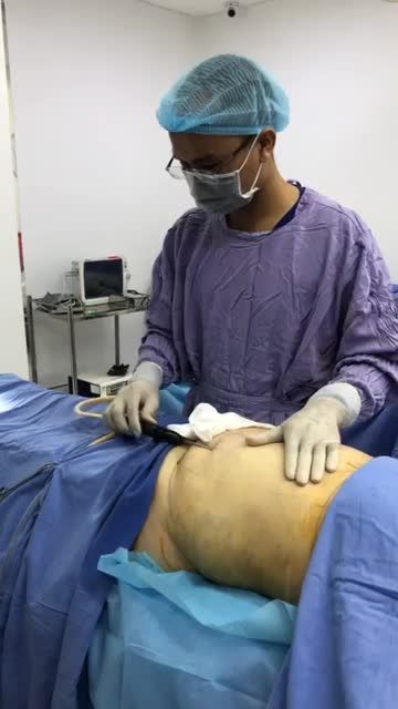 Cận cảnh quá trình hút mỡ Tại bệnh viện thẩm Mỹ Đông Á