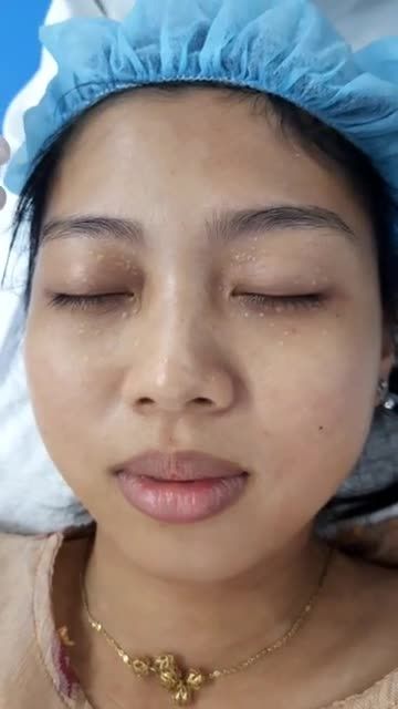 Quá trình điều trị mụn thịt với công nghệ Laser Co2