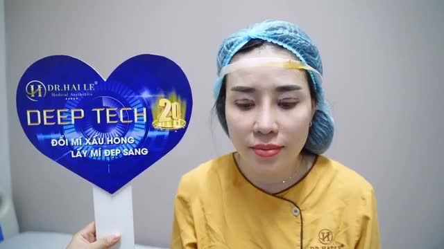 Tiếp tục giải cứu thành công ca mí lỗi hỏng do thực hiện thẩm mỹ mắt tại cơ sở không uy tín