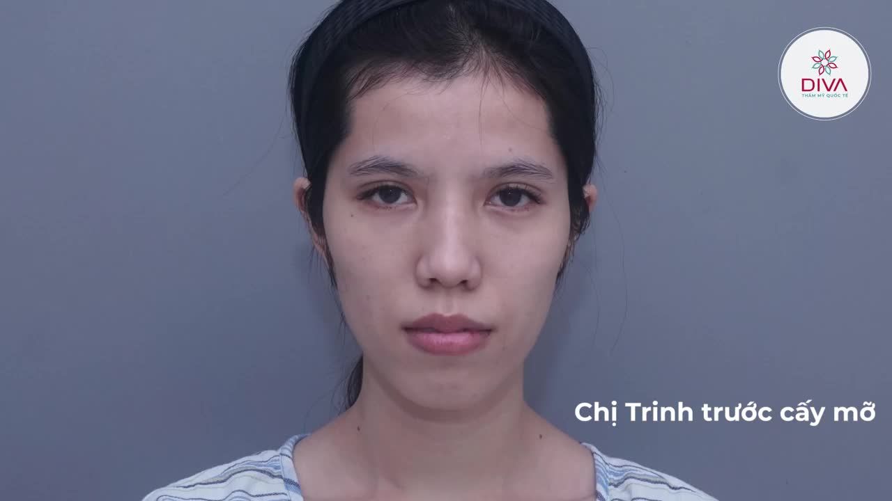 CẤY MỠ MẶT – QUAY NGƯỢC THỜI GIAN, LẤY LẠI THANH XUÂN!