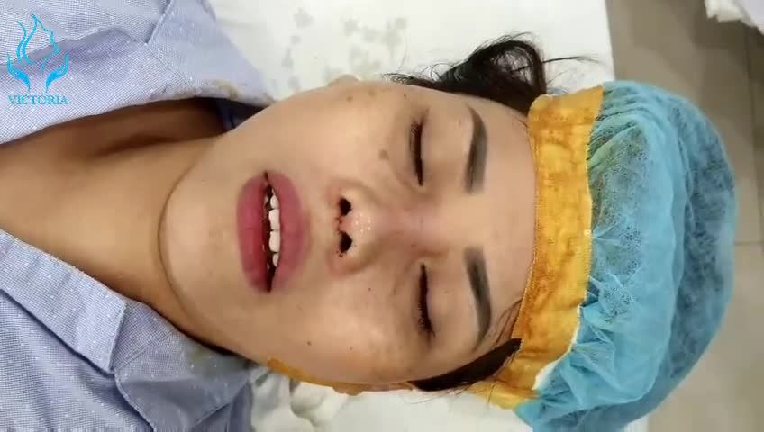 DR.THÔNG VỪA THỰC HIỆN XONG CA NÂNG MŨI CẤU TRÚC SỬA LẠI