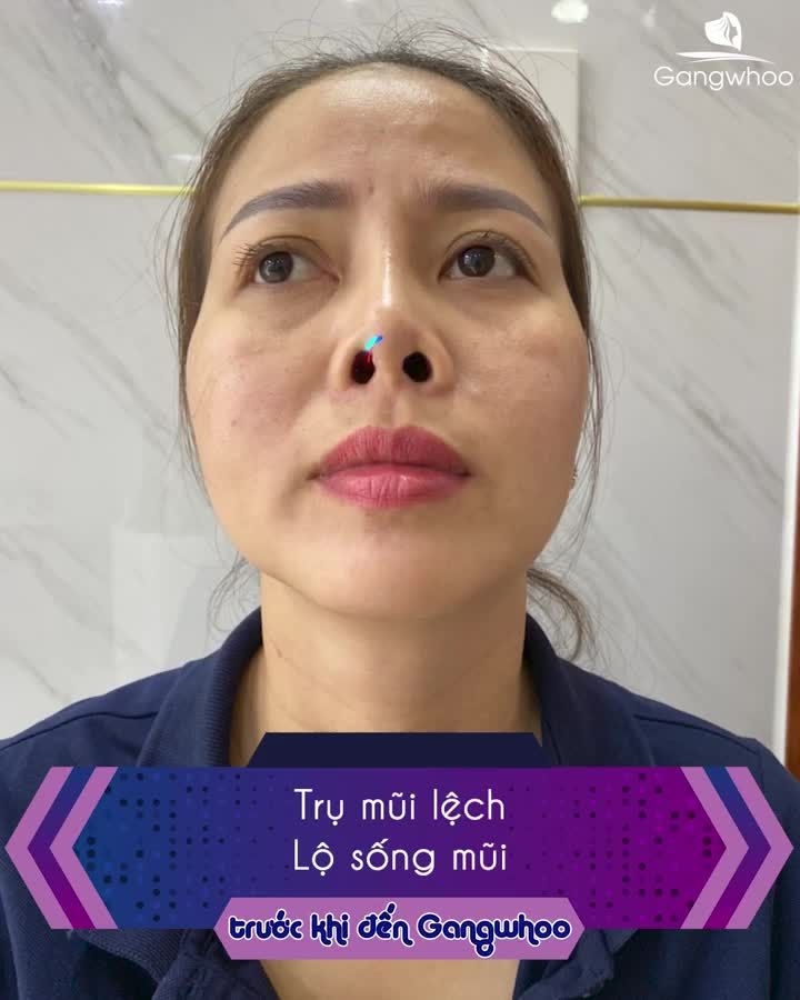 TOP 5 TRƯỜNG HỢP MŨI HỎNG THƯỜNG GẶP ĐƯỢC GIẢI CỨU BỞI GANGWHOO