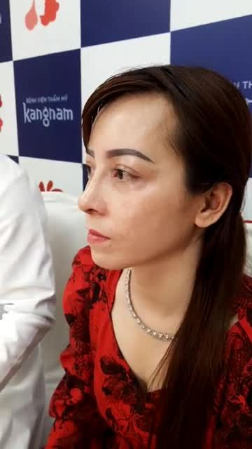 Mũi có sống nhưng lệch, trụ mũi hếch làm kém duyên gương mặt?