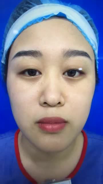 Mũi đẹp xuất thần sau 7 ngày phẫu thuật - NÂNG MŨI CẤU TRÚC 4D với ĐÔNG GIÁ 20 triệu trong trương trình THẨM MỸ ĐỒNG GIÁ THÁNG 10.