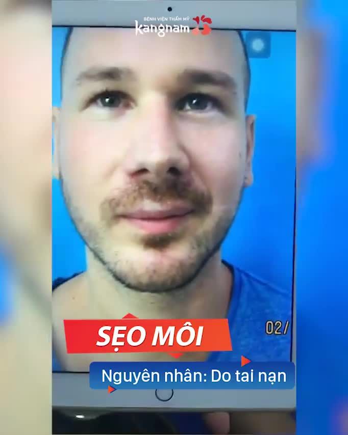 Khách hàng SỬA SẸO MÔI - TẠO HÌNH MÔI - Hóa Nam Thần