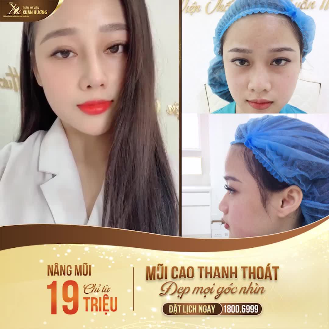 MŨI ÔM FORM THANH THOÁT - ĐẸP TỰ NHIÊN CHỈ SAU 7 NGÀY