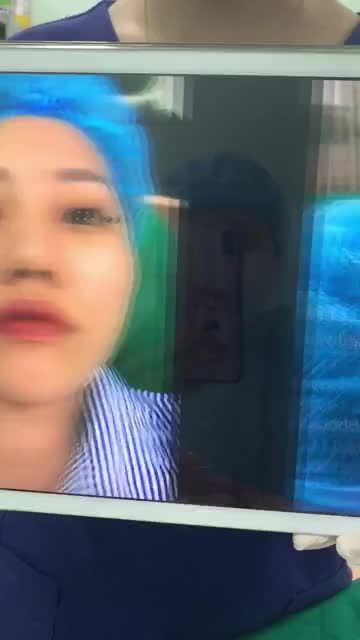 MŨI SỬA LẠI CẤU TRÚC MEGADERM SAU 11 NĂM