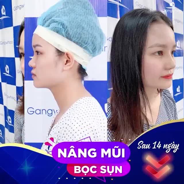 NÂNG MŨI BỌC SỤN - KHẮC PHỤC THÀNH CÔNG SỐNG MŨI THẤP, TO, THÔ