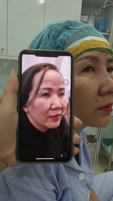 NÂNG MŨI CẤU TRÚC CHỈNH XƯƠNG THÔ BÈ VỪA THỰC HIỆN XONG