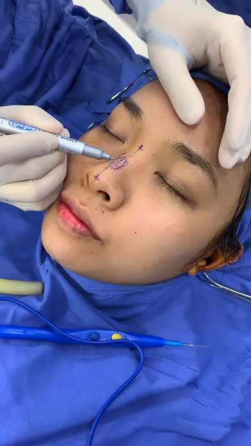 Bs Kangnam lên kế hoạch phẫu thuật Nâng mũi cấu trúc chỉnh xương tại kangnam