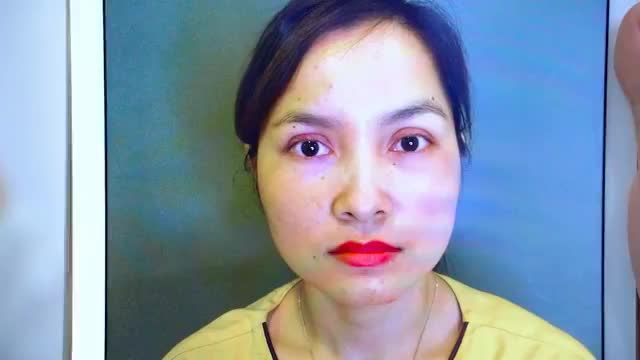 GIẢI CỨU THÀNH CÔNG CA CẮT MÍ LỖI HỎNG DO THỰC HIỆN TẠI CƠ SỞ KHÔNG UY TÍN BẰNG PP SỬA MÍ DEEPTECH20 - MỜI QUÝ KHÁCH HÀNG CÙNG THEO DÕI