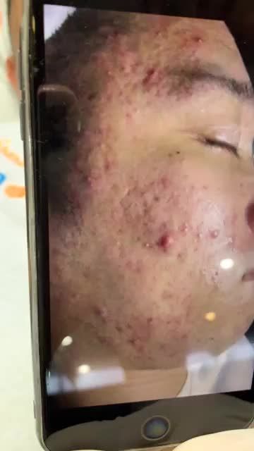 Quy trình điều trị mụn với công nghệ mới De-acne tại BVTM KANGNAM