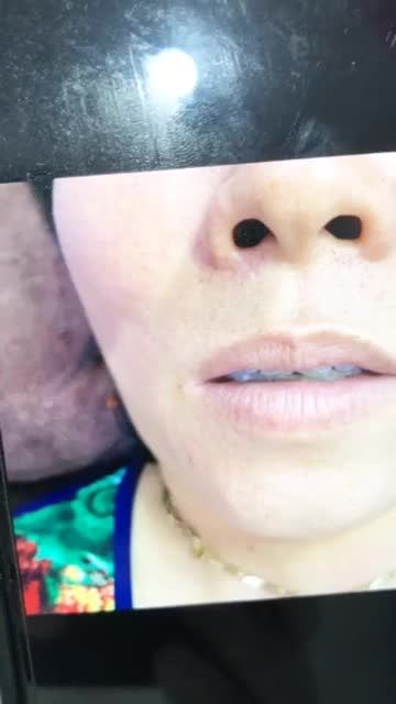 Môi thâm , sắc tố môi không đều, thiếu sắc nét - Xử lí thế nào?