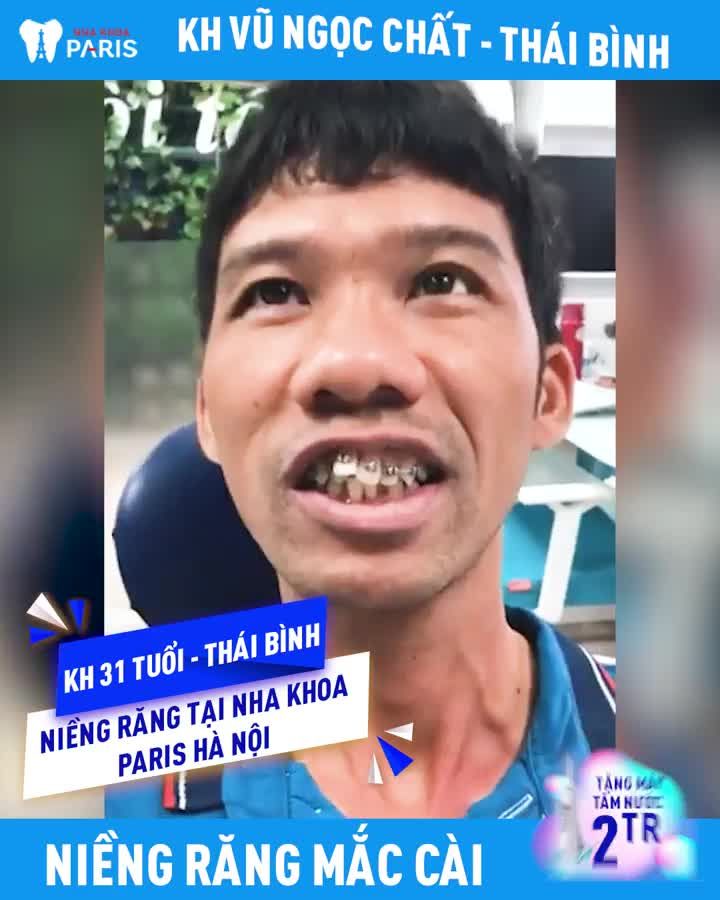 31 Tuổi Niềng Răng Chưa Phải Là Muộn