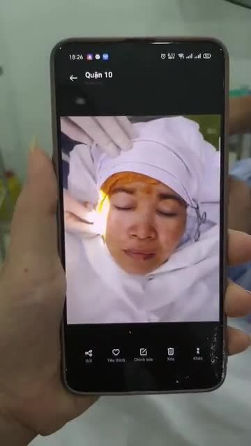 CA MŨI BÁN CẤU TRÚC SLINE CUỐI NGÀY