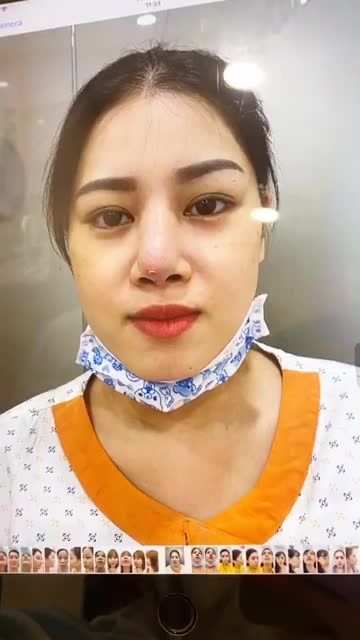 Ca xử lý cho khách hàng mũi nhiễm trùng nặng + lộ sụn đầu mũi