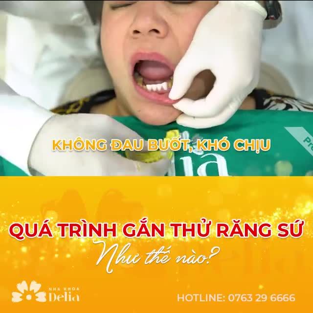 CẬN CẢNH QUÁ TRÌNH GẮN THỬ RĂNG SỨ TẠI DELIA