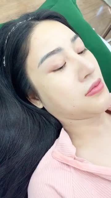 13 KHÁCH TÁI KHÁM SAU KHI XỬ LÝ SILICON CẰM TẠI BÁC SĨ