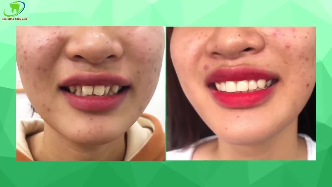 THAY ÁO MỚI CHO RĂNG - THĂNG HẠNG NỤ CƯỜI