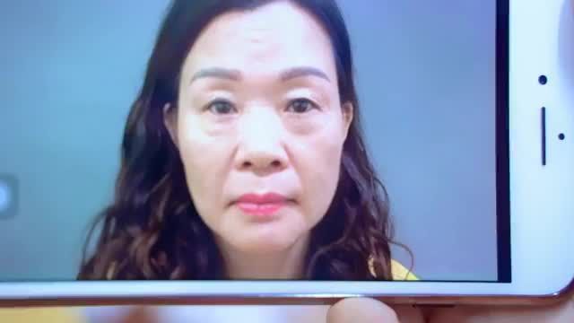 Loại bỏ mỡ phì đại gây nặng mắt mí dưới bằng kỹ thuật Cắt mí dưới an toàn tại Dr.Hải Lê