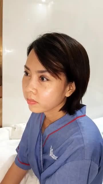 Cận cảnh kết quả sau 1 ngày CHỈNH HÌNH HÀM HÔ