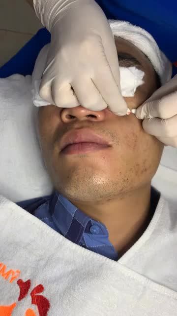 Mụn trứng cả, viêm nhiễm do khách hàng sử dụng rượu thuốc, kem trị mụn không rõ nguồn gốc