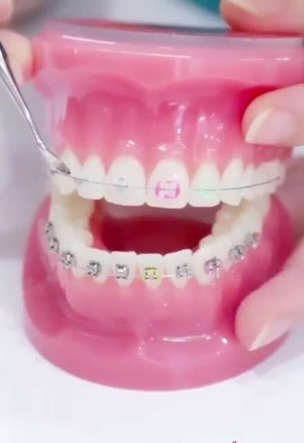 BẠN HÃY CHỌN Niềng răng tại VIET SMILE bởi