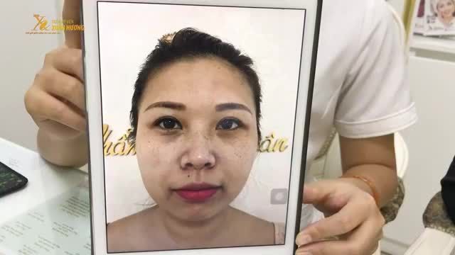 KHÁCH HÀNG TÁI KHÁM SAU 1 BUỔI XỬ LÝ TÀN NHANG 15 NĂM VÀ MỰC XĂM MÍ TRỔ XANH ĐEN