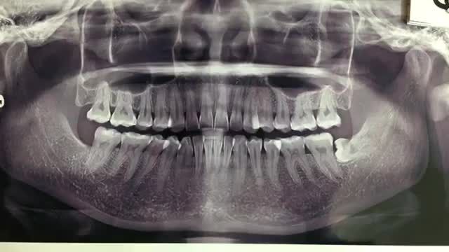 Nhổ răng khôn số 38 mọc ngầm lệch 90 độ cho chị Ngọc tại nha khoa Thùy Anh.