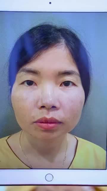 Thay đổi Đôi mắt thay đổi diện mạo rạng ngời tươi trẻ với phương pháp Cắt mí hạn chế sưng nề, bầm tím, đau nhức tại Dr.Hải Lê