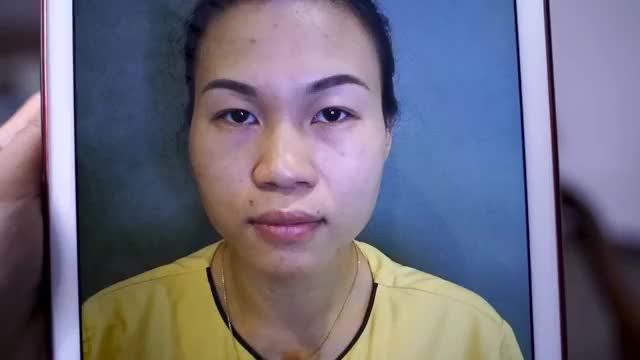 "Làm mí không đa tí nào bạn à" là lời chia sẻ của vị khách hàng thực hiện Cắt mí sau 7 ngày mời quý khách hàng cùng theo dõi để có thêm kinh nghiệm và động lực