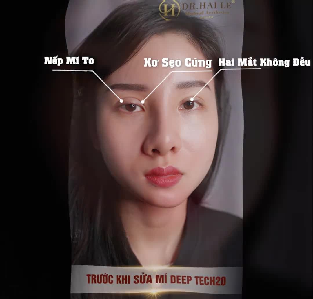 BẠN CHƯA CÓ MỘT ĐÔI MẮT VỚI NẾP MÍ ĐẸP - CHỈ LÀ BẠN CHƯA ĐẾN VỚI DR.HẢI LÊ THÔI.!!!