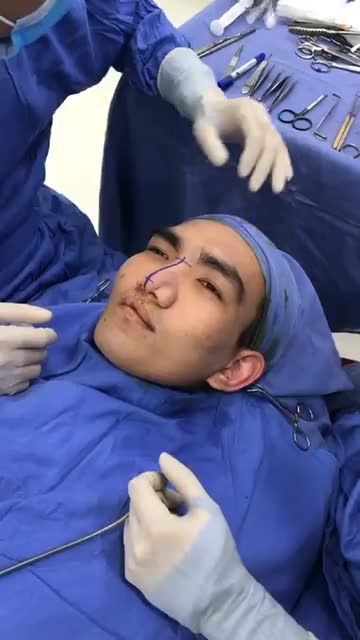 Mũi lệch sóng, đầu mũi to và sẹo môi! Live stream trực tiếp QUY TRÌNH phân tích và thiết kế dáng mũi và môi cho anh khách hàng