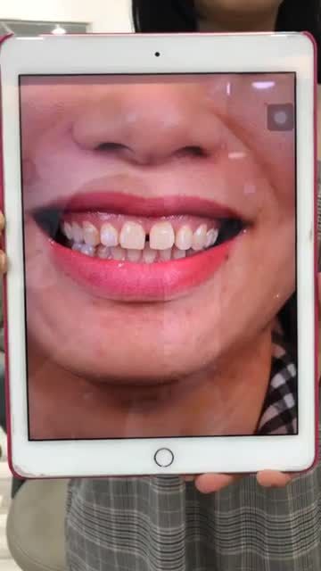 Chị KH xinh đẹp vừa làm xong 16 răng sứ thẩm mỹ tại Delia