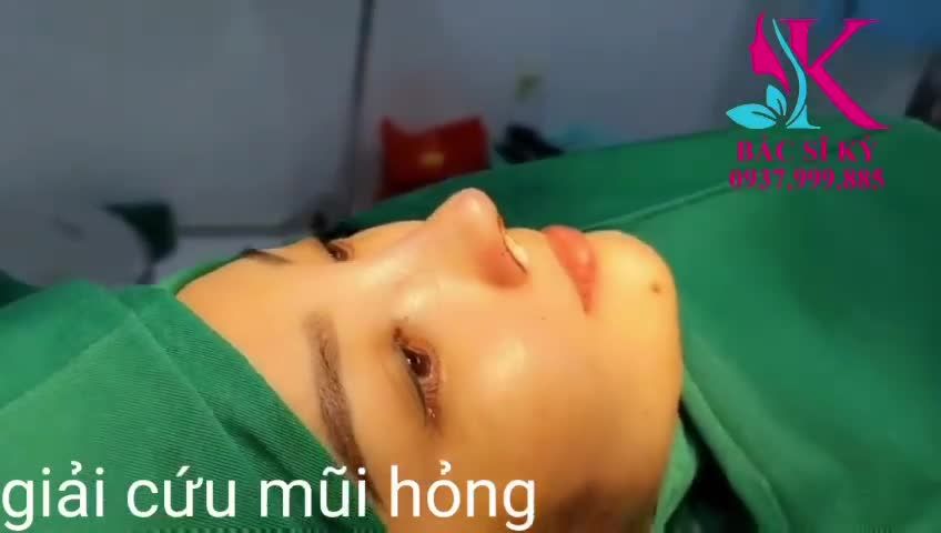GIẢI CƯU MŨI  Khắc phục lại thành dáng mũi phong thuỷ- Đầu mũi bay - Túi mật