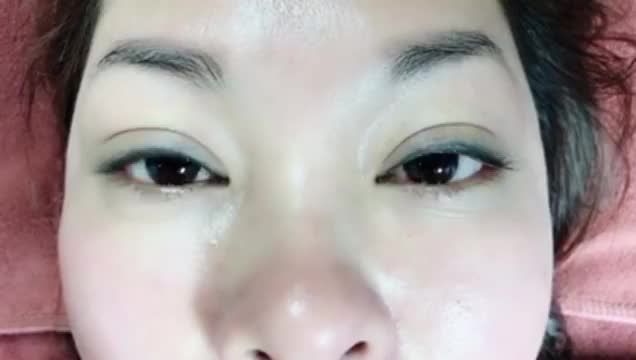 CẮT MÍ SAU BAO NHIÊU LÂU SẼ ĐẸP TỰ NHIÊN? MỜI QUÝ KHÁCH HÀNG THEO DÕI KẾT QUẢ CẮT MÍ SAU 1 NĂM TẠI DR.HẢI LÊ ĐỂ CÓ CÂU TRẢ LỜI.!
